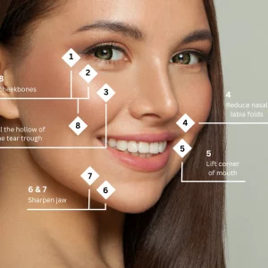 Close-up of a smiling woman with facial contouring treatment areas highlighted and labeled, including cheekbone definition, tear trough filling, reducing nasal folds, lifting mouth corners, and sharpening the jawline.