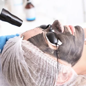 Woman undergoing a carbon laser facial treatment with a black carbon mask applied on her face, protective goggles over her eyes, and a specialist using a handheld laser device on her skin.