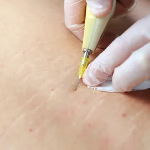 Close-up of a medical professional wearing gloves using a microneedling or skin treatment device on a patient's skin with visible stretch marks and redness.
