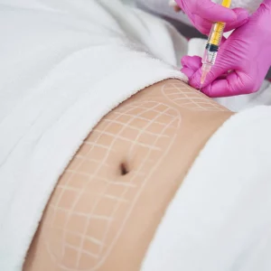 Close-up of a cosmetic procedure being performed on a woman’s abdomen, with a syringe and treatment grid markings on the skin, indicating a targeted fat reduction or skin-tightening treatment.