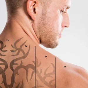 A man showing the progressive fading of a large tribal-style tattoo on his back and shoulder, labeled from 1x to 5x to represent different stages of laser tattoo removal treatments.