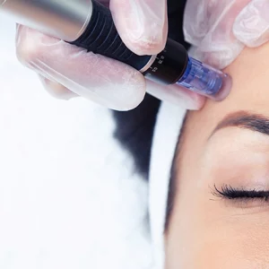 Close-up of a woman receiving microneedling treatment on her forehead using a dermapen device, administered by a professional wearing clear disposable gloves.