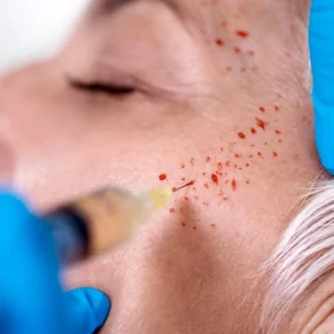 Close-up of a cosmetic procedure where a syringe is used to inject a treatment into a woman's cheek, with visible pinpoint bleeding, possibly during a platelet-rich plasma (PRP) or mesotherapy session.