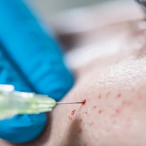 Close-up of a skin rejuvenation treatment using a syringe, showing microinjections on a person's cheek with pinpoint bleeding, likely part of a mesotherapy or PRP facial procedure.