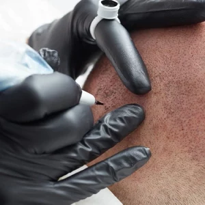 A technician wearing black gloves performs a scalp micropigmentation procedure on a bald man's head using a specialized tattoo machine to create the appearance of hair follicles.
