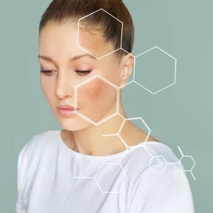 Portrait of a woman with clear skin looking down, overlaid with translucent white hexagon graphics highlighting areas of pigmentation or skin concern on her face. The image symbolizes dermatological analysis or skincare treatment targeting uneven skin tone or discoloration.