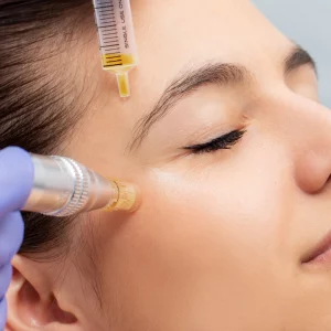 Close-up of a woman receiving a cosmetic microneedling treatment on the side of her face. A gloved practitioner uses a microneedling device while a serum is being dispensed from a syringe for skin rejuvenation. The woman has her eyes closed and appears relaxed.