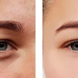 Close-up comparison of a person's eye area before and after a cosmetic treatment, showing reduced under-eye bags and smoother skin on the right side.