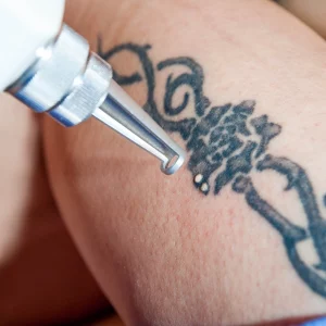 Close-up view of a laser device being used for tattoo removal on a person's skin, focusing on a dark, intricate tattoo design.