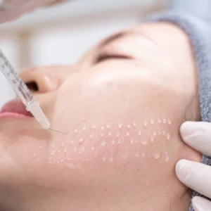 Close-up of a woman receiving multiple microinjections on the cheek during a mesotherapy or skin booster treatment, showing tiny raised droplets on the skin and a syringe administered by a gloved professional.