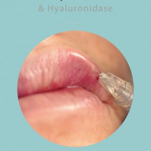 Close-up of a syringe injecting into a person's upper lip, illustrating a treatment for complications related to dermal fillers using hyaluronidase.