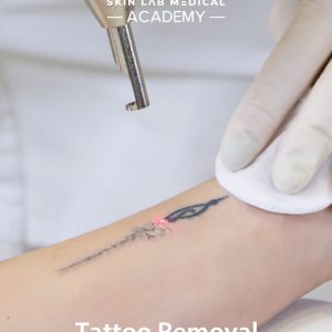 Laser tattoo removal procedure in progress on a person's forearm, performed by a specialist at Skin Lab Medical Academy.