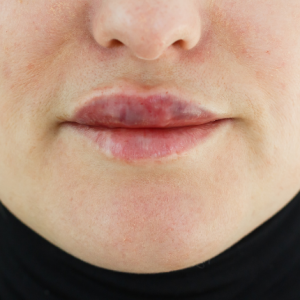 Complications & Hyaluronidase